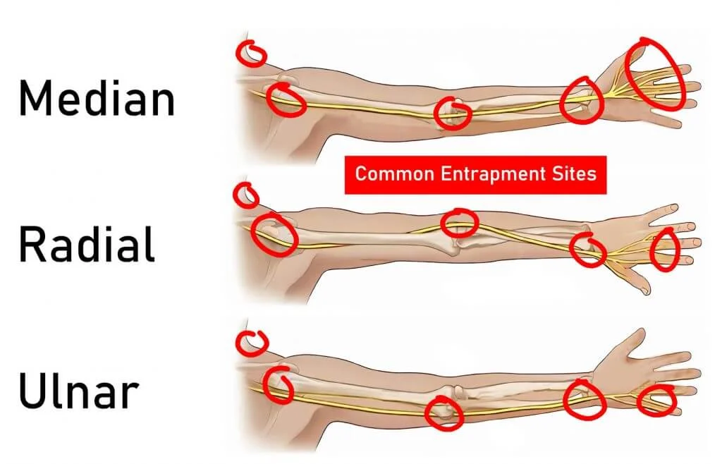 How To Fix Ulnar Nerve Entrapment Causes And Symptoms Gymless